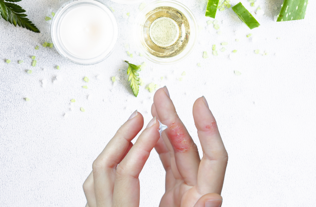 Kosmetyki wspomagające pielęgnację skóry z łuszczycą